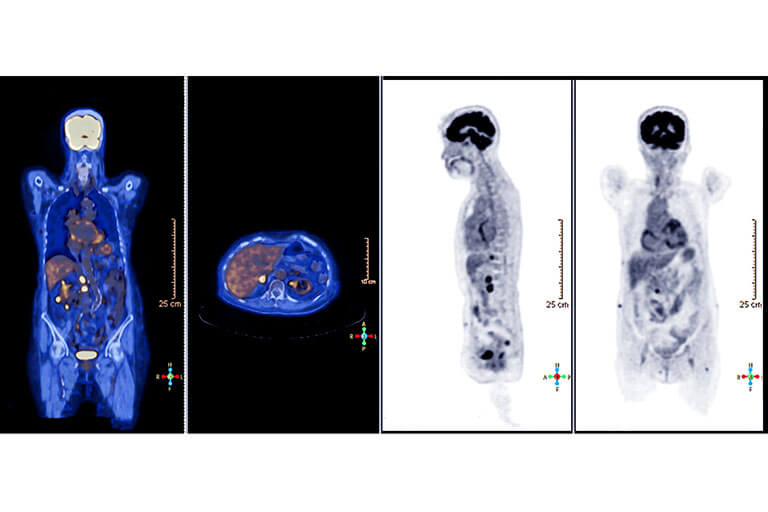 【全身がん検査】MRI検査(DWIドック)とPET検査の基礎知識を解説
